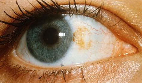 ocular melanoma prognosis for patients