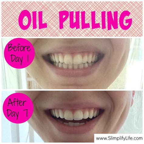 Do You Do Oil Pulling Before Or After Brushing Teeth