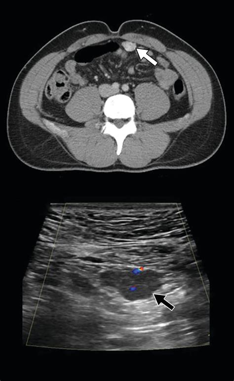 omental biopsy