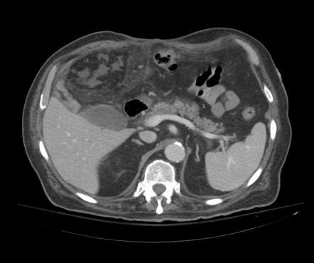 omental infarction radiopaedia