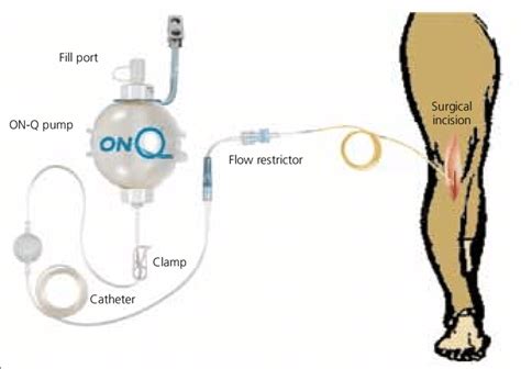 On Q Pump Knee Replacement
