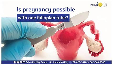 Can you still have a baby with one fallopian tube? I.A.S