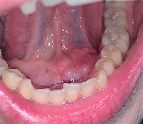one side of floor of mouth swollen