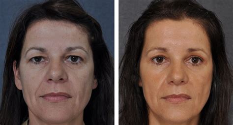 one sided brow lift cost