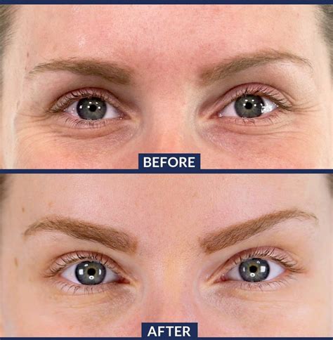 one sided brow lift cost