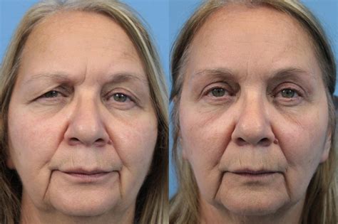 one sided brow lift