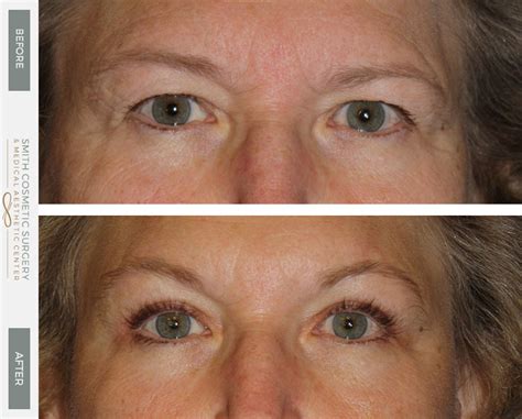 one sided brow lift