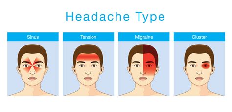 one sided migraine headache