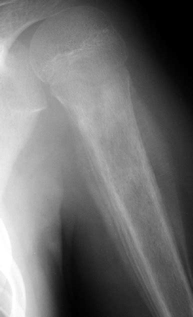 Onion Skin Ewing Sarcoma