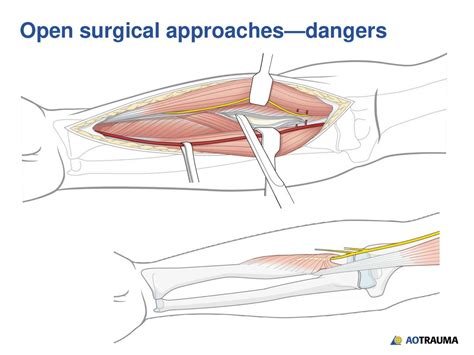 Open Approach Meaning