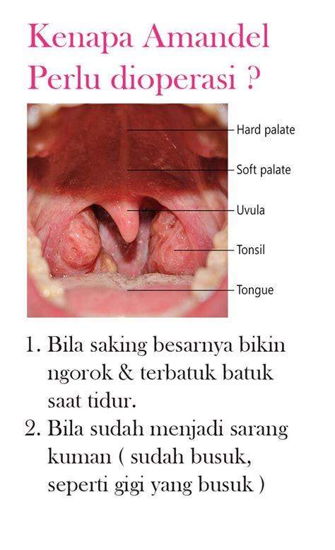 operasi amandel