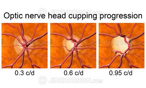 Optic Disc Glaucoma Cupping