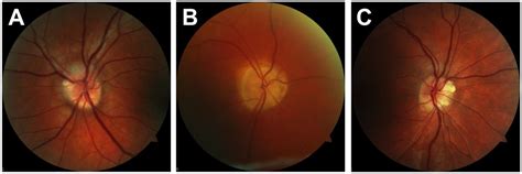 Optic Disc Normal Color
