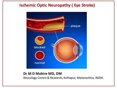 Optic Nerve Eye Stroke