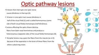 Optic Pathways And Lesions
