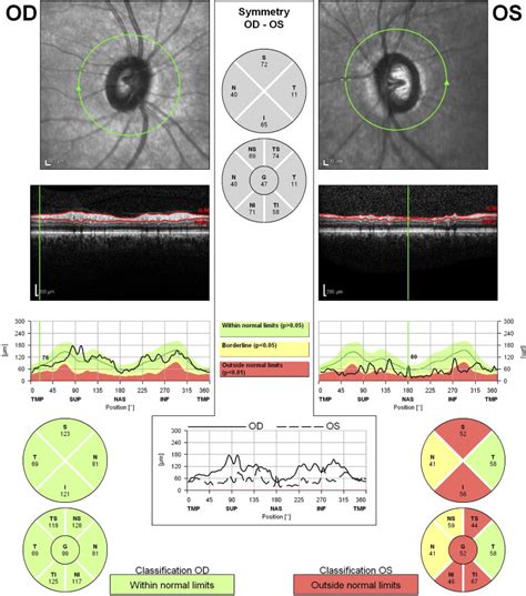Optical Coherence Tomography For Glaucoma