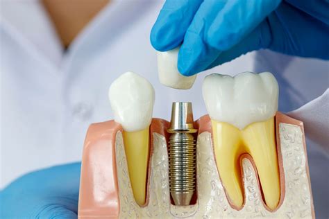 options for dental implants