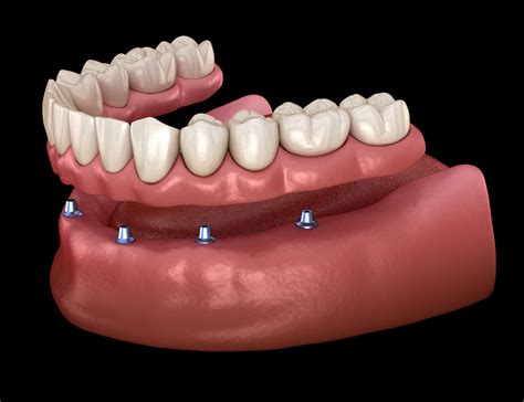 options for teeth implants