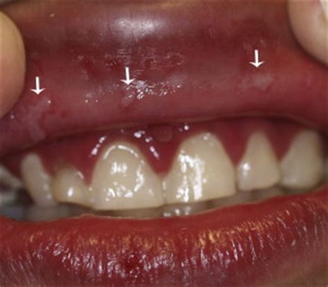 oral herpes simplex infection icd 10
