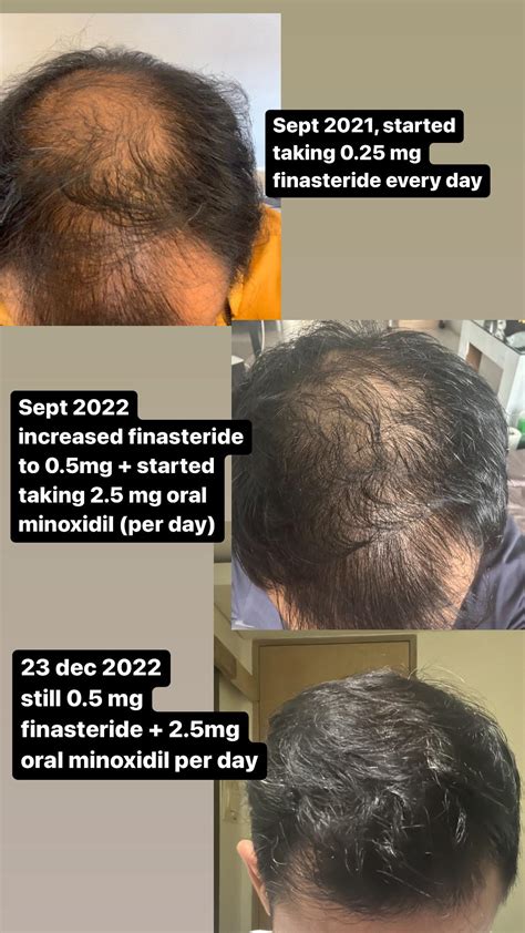 oral minoxidil with finasteride