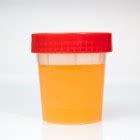 oranje kleur urine