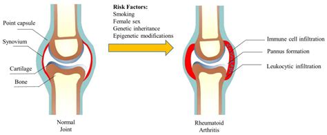 Origin Of Arthritis