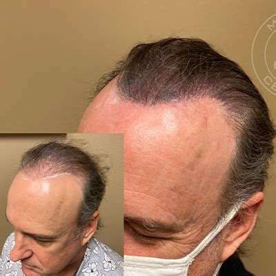 Hair Transplant near me in Orlando Hair Restoration and Replacement