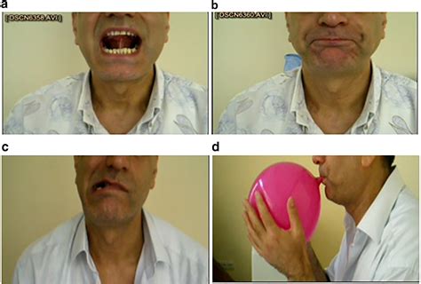 oropharyngeal exercises for sleep apnea