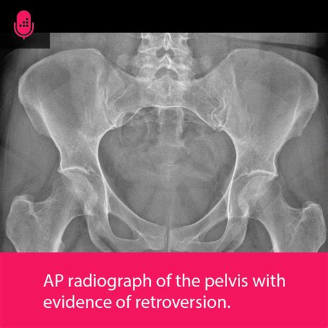 orthobullets hip labral tear