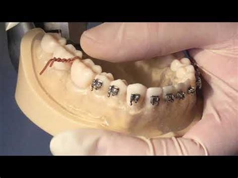 Orthodontic Brass Wire Separator