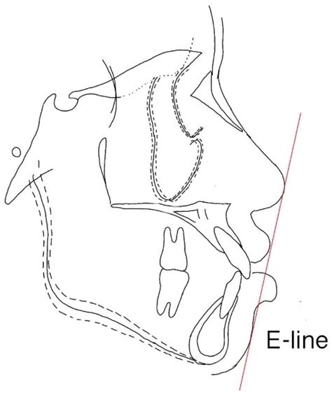 Orthodontic E Line