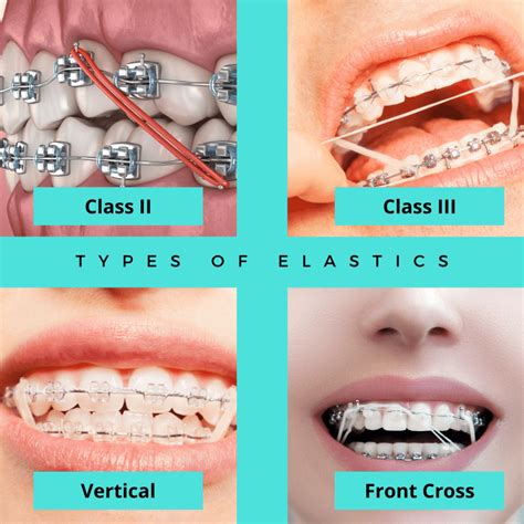 Orthodontic Elastic Classification