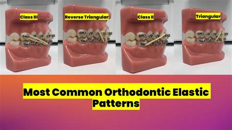 Orthodontic Elastic Patterns