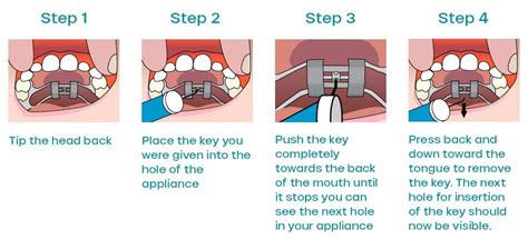 Orthodontic Expander Instructions