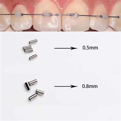 Orthodontic Stopper