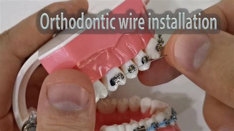 Orthodontic Wire Purpose