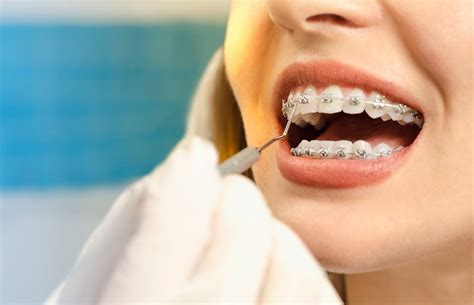 Orthodontics Braces Help