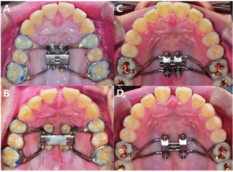 Orthodontics Expander Cost