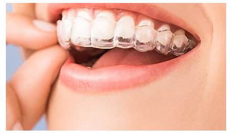 Orthodontiste Gouttiere Transparente Appareil Dentaire Pour Adultes Jusqu'à 5000 Euros Le