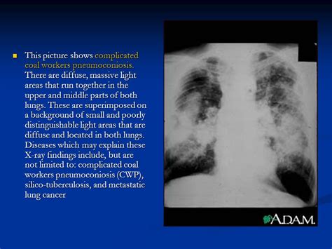 osha asbestos chest x ray guidelines