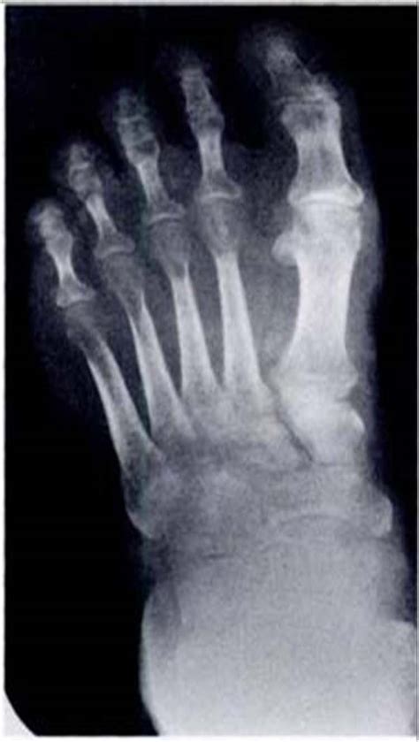 osseous demineralization foot