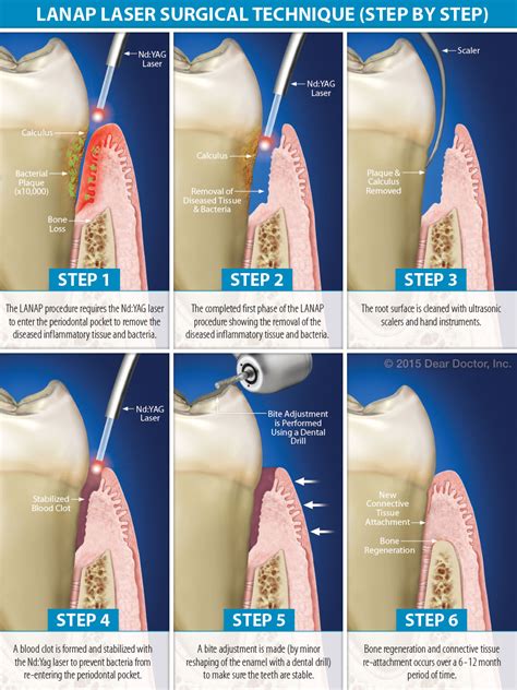 osseous laser surgery for periodontal disease