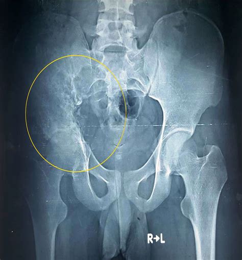 osseous lesions pelvis