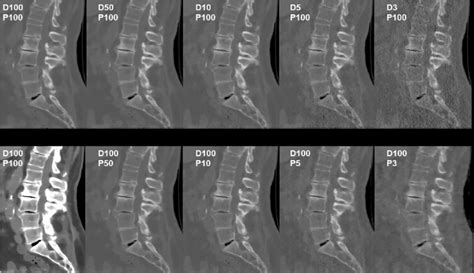 osseous structures degenerative changes