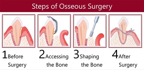 osseous surgery definition dental