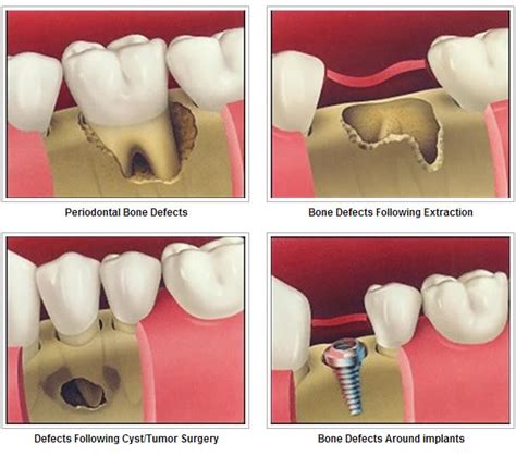 osseous surgery with bone graft