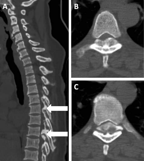 ossification of the spine