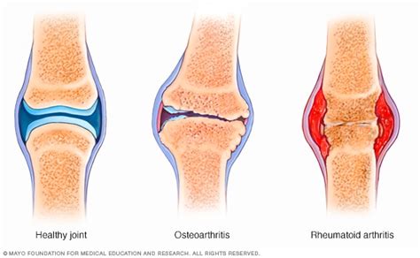 osteoartritis