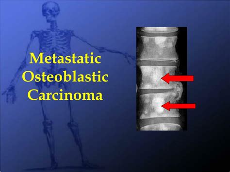 osteoblastic metastatic disease icd 10