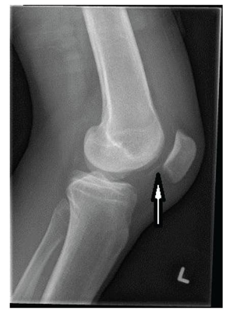 osteochondral fracture recovery time